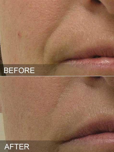 Before & After hydrafacial nasolabial folds westchester